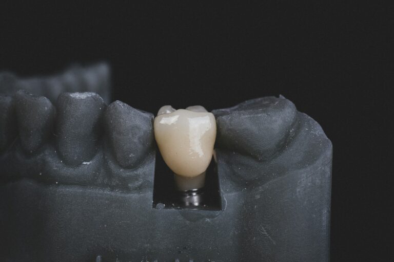 ceramic crown on dental implant